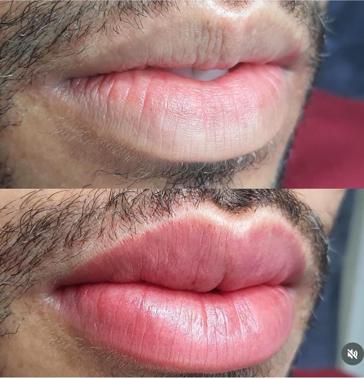 Micro Labial